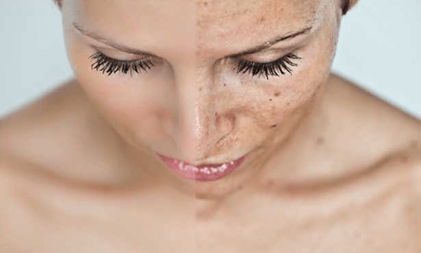 Mole Remover App App To Remove Dark Spot From Photo