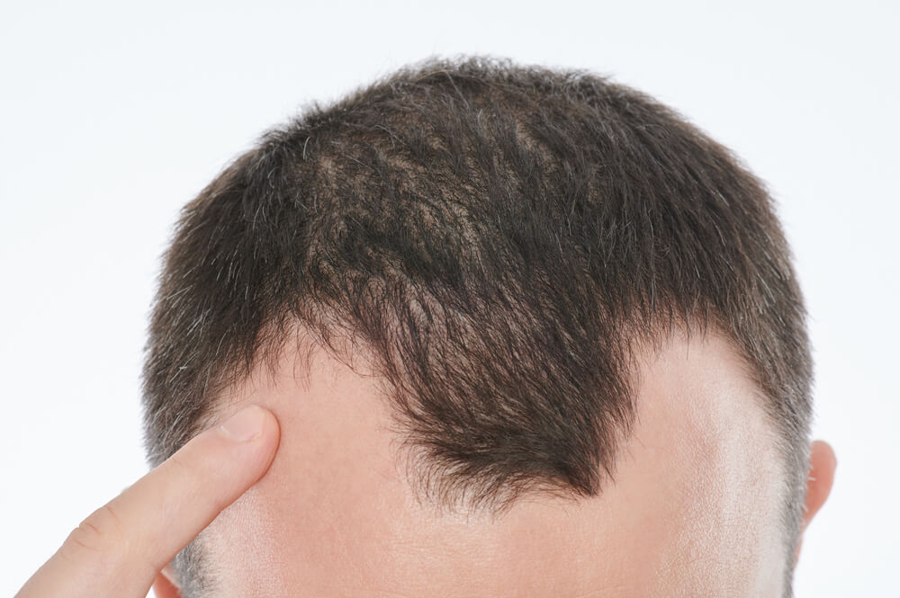 Hide Baldness app - Hide Bald Spots in a Photo | Retouchme